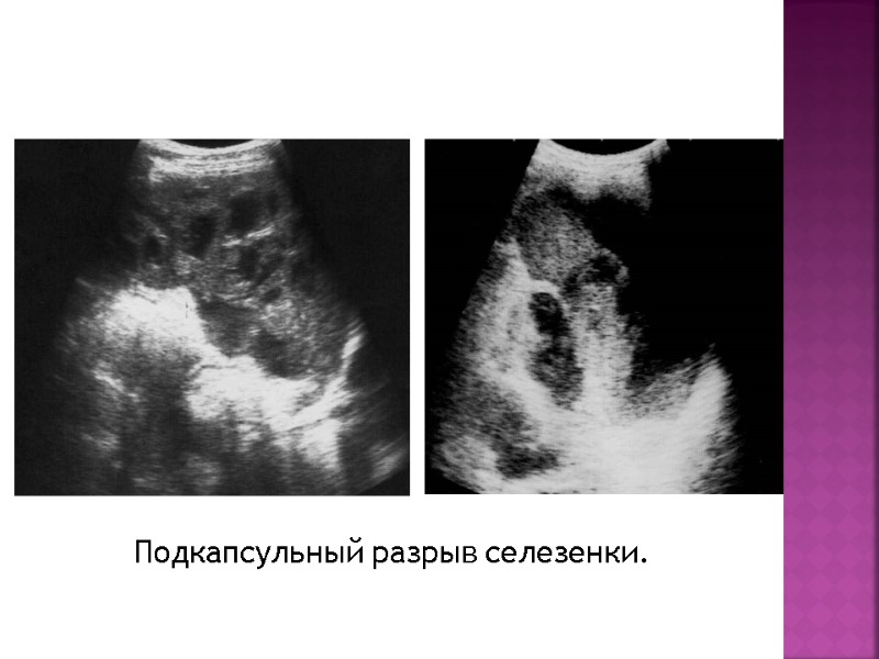 Подкапсульный разрыв селезенки.
